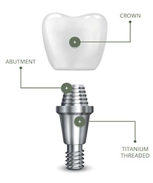 Image of a dental implant