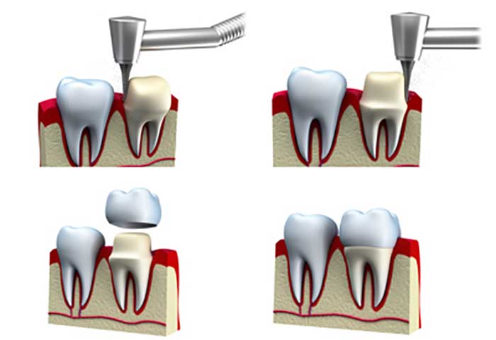Crown Placement Procedure