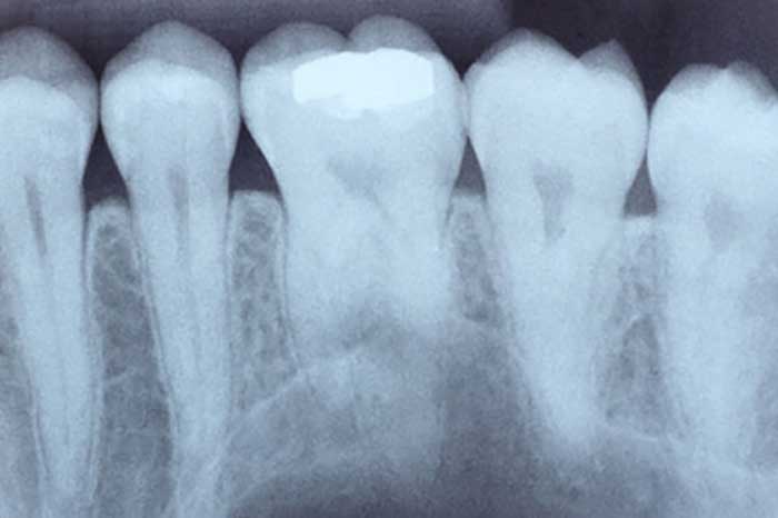 Digital X-ray of Teeth in McAllen, TX 