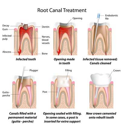 Root Canal in McAllen