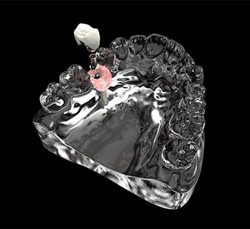 Dental Implants in McAllen, TX