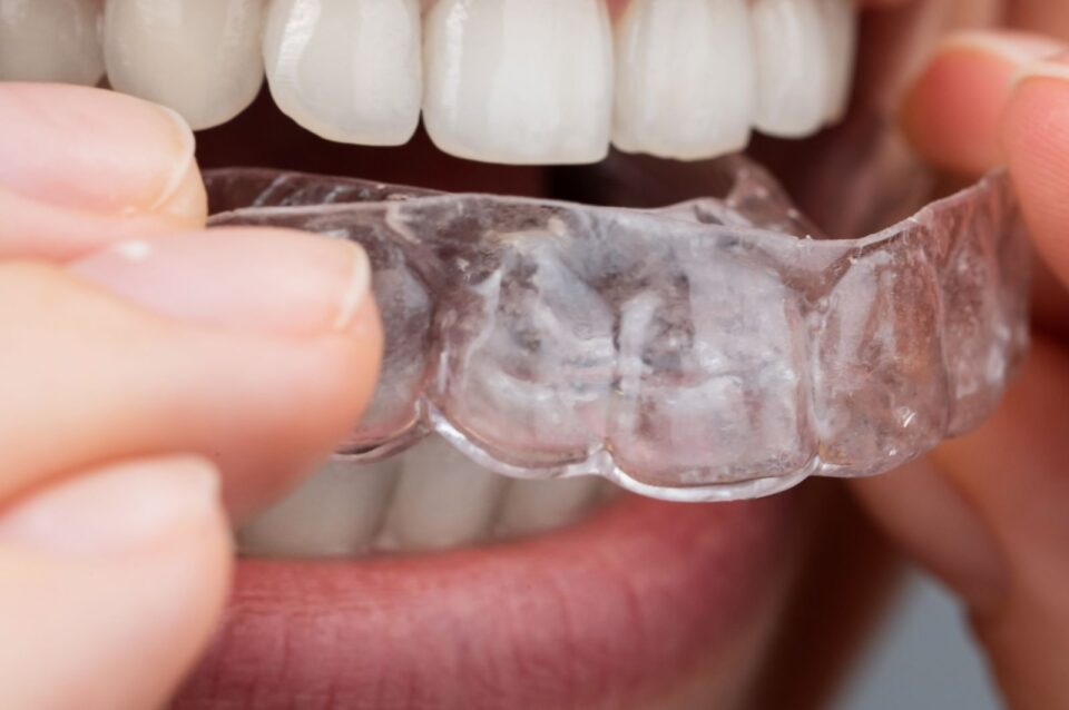 Custom Dental Night Guard in McAllen, TX