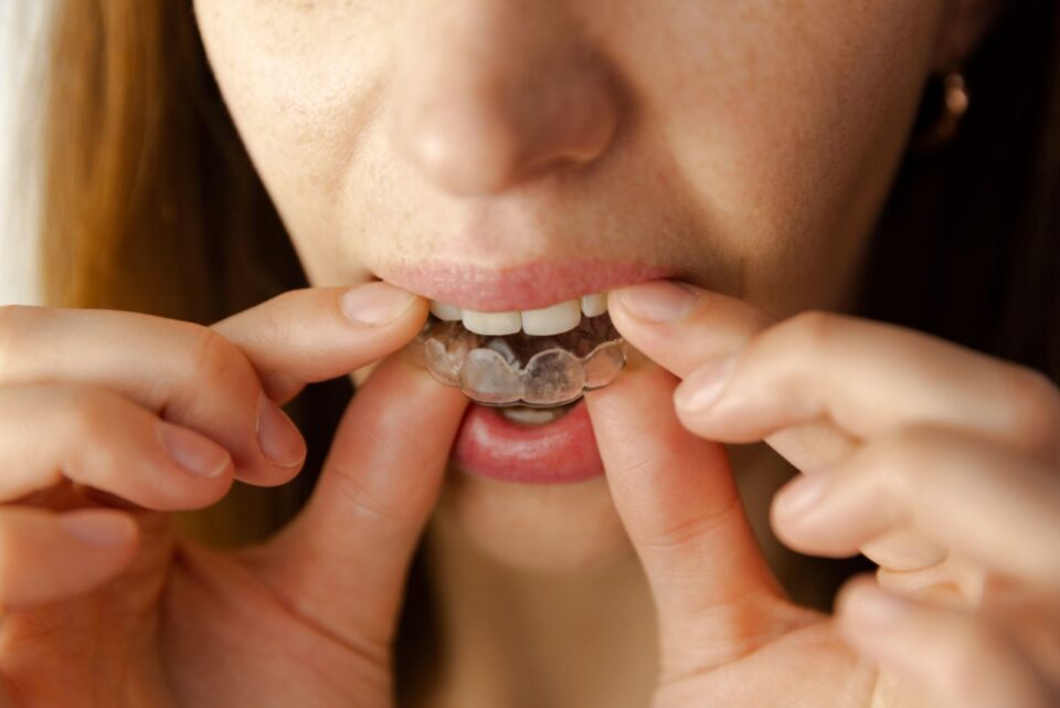 Custom Dental Night Guards in McAllen