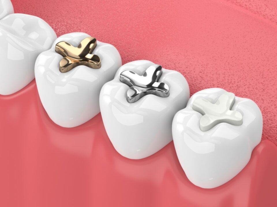 Dental Restoration Sealants in McAllen, TX