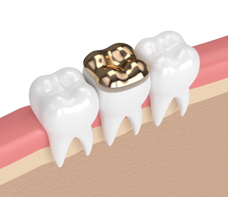 Dental Sealants in McAllen, TX