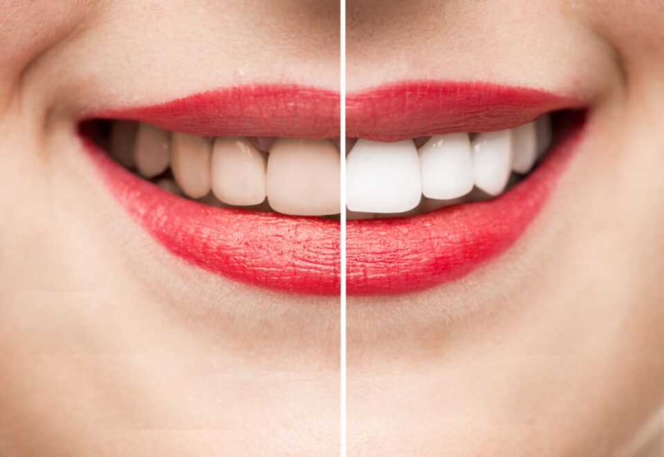 Smile Makeovers in McAllen, TX