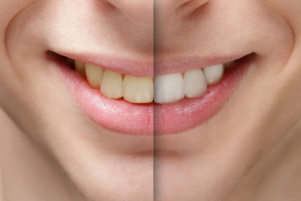 Smile Makeover Transformation in McAllen, TX