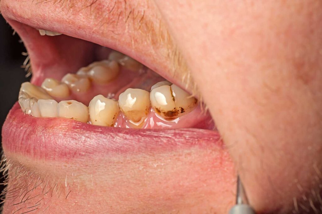 Close-up of teeth with visible plaque buildup and inflamed gums indicating gingivitis
