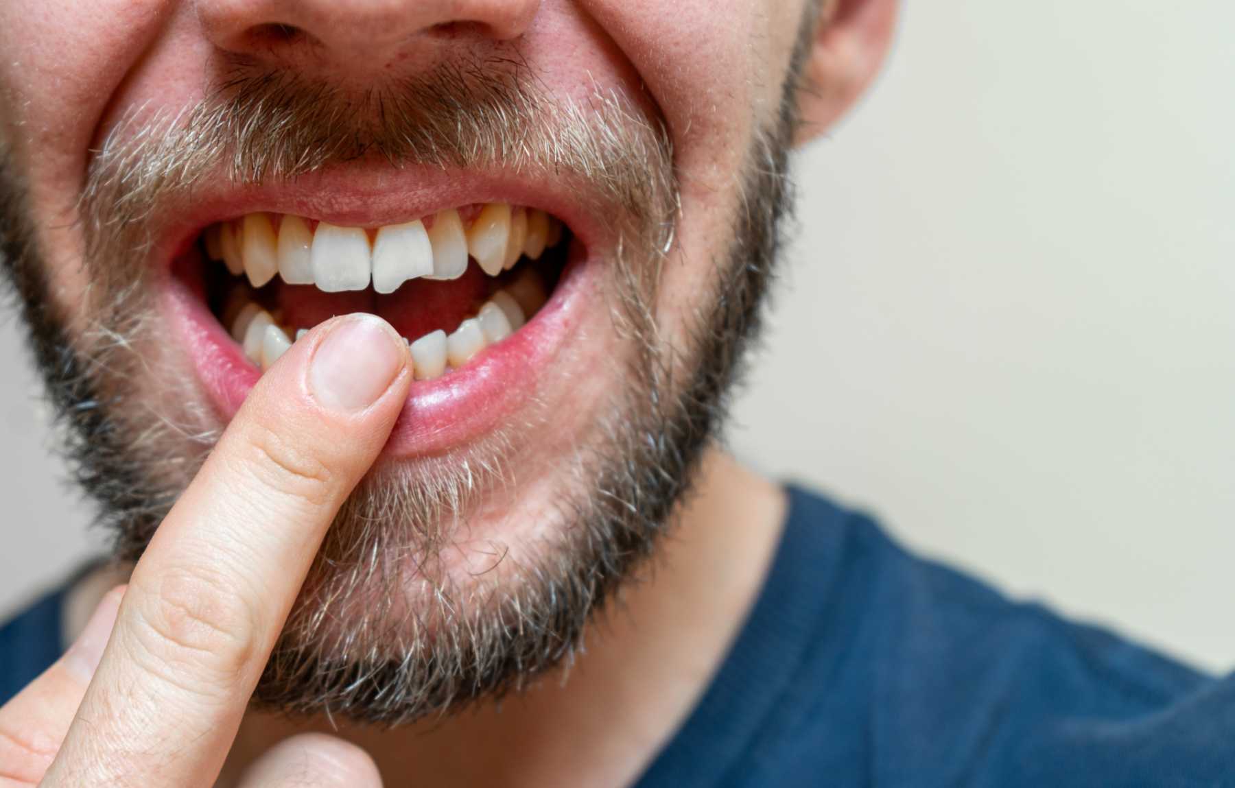 Visible chipped tooth prior to dental restoration in McAllen, TX