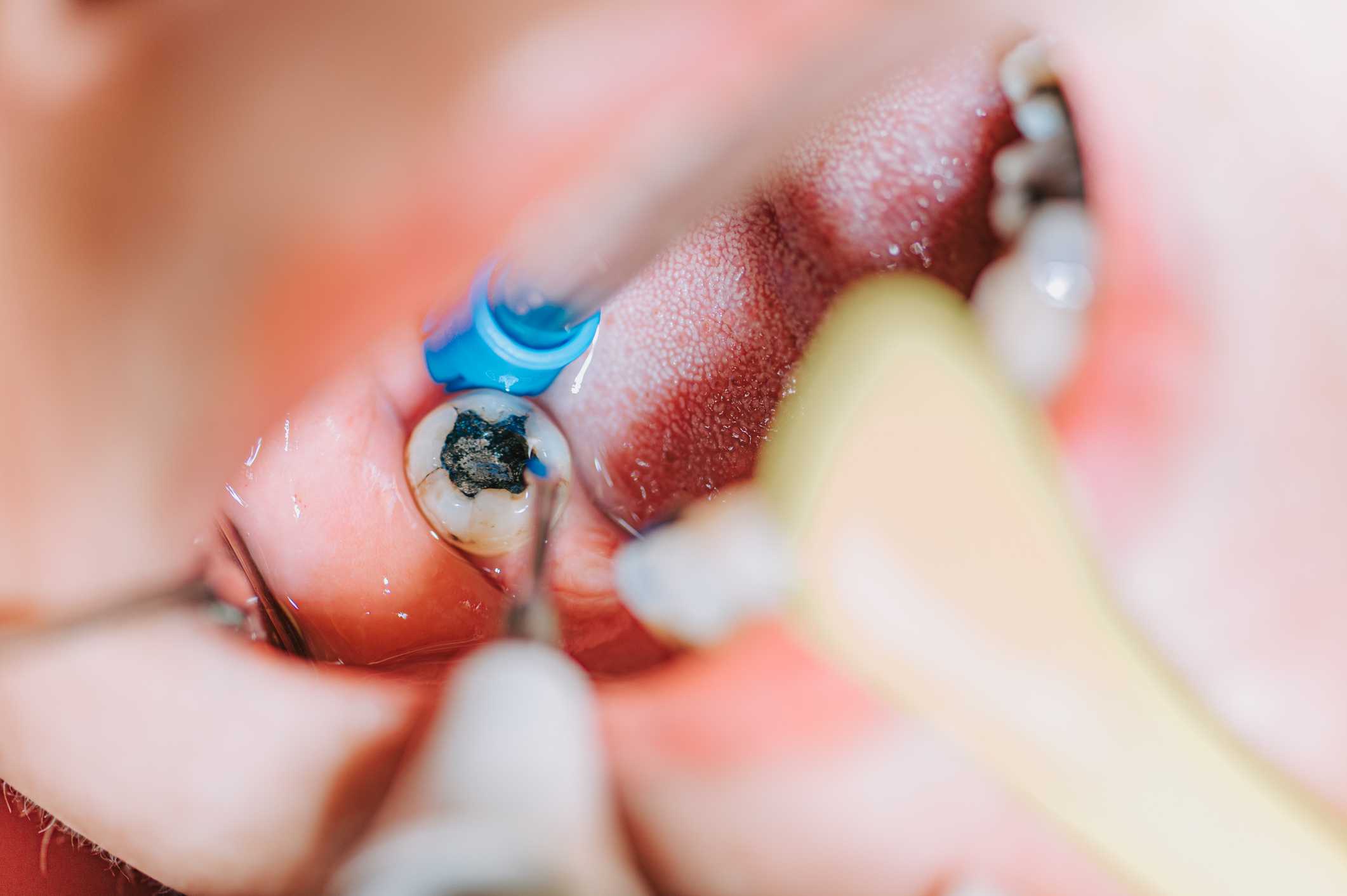 Dental cavity in a molar tooth being cleaned by a dentist in McAllen, TX